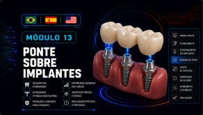 Ponte sobre Implantes