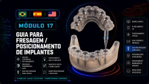 Guia para Fresagem de Implantes